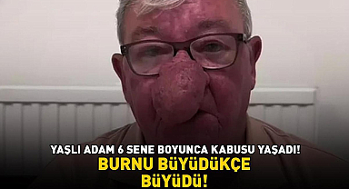 Burnu büyüdükçe büyüdü! 68 yaşındaki adam kabusu yaşadı! 4 saatlik operasyonla adeta yeniden doğdu - Sağlık Haberleri