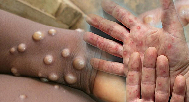 DSÖ'den M çiçeği virüsü uyarısı: Salgın kıtayı aştı! 'Kontrol altına alınmalı'