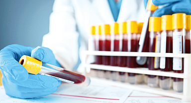 Alzheimer'da kan testi umudu