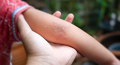 Cam bardak testiyle anlaşılabiliyor! Menenjitte hayati uyarı