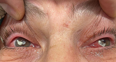 Kırlangıç otu felaketi: Gözlükten kurtulmak istedi, gözlerini açamaz hale geldi!