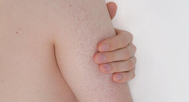 Vücutta Kırmızı Lekeler Neden Olur? Vücuttaki Kırmızı Lekeler noktalar Nasıl Geçer?